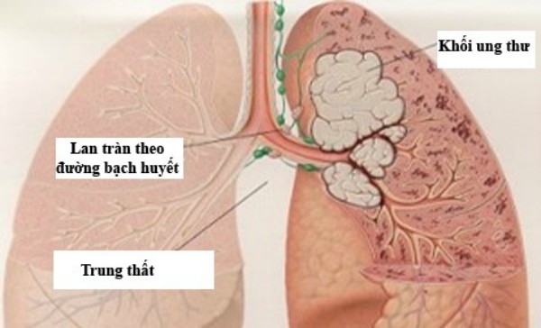 Rất nhiều người khi tức giận nhất vùng phổi có thể bị đau, đây là bởi vì tức giận có thể làm tổn thương phổi.